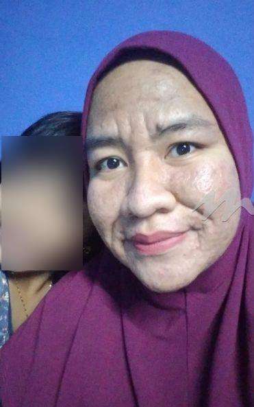 Kondisi Ain makin membaik setelah melahirkan.