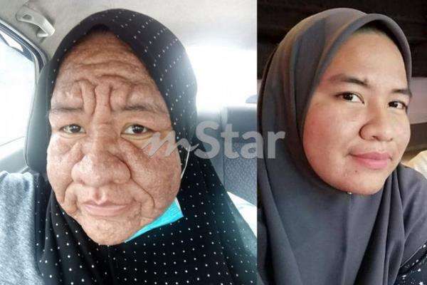 Ain menderita alergi anek sejak kandungannya berusia 2 bulan.