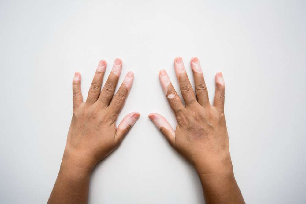 Vitiligo Pada Tangan