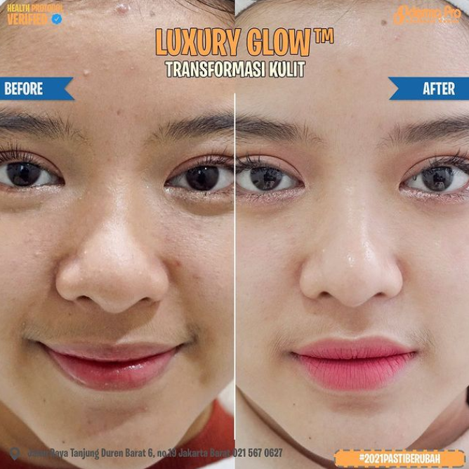 Before After Wajah Tiara Andini Setelah Perawatan Kulit