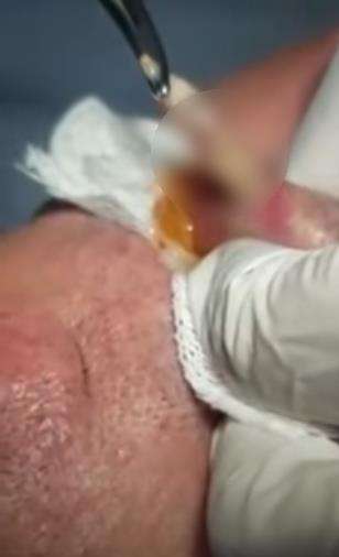 Bibir bengkak dikira bisulan, ternya jadi sarang larva lalat.