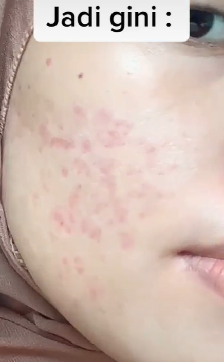 Bekas Jerawat
