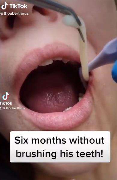 Tak gosok gigi enam bulan muncul benda mirip cacing, cek faktanya.