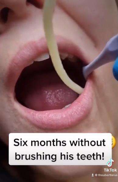 Tak gosok gigi enam bulan muncul benda mirip cacing, cek faktanya.