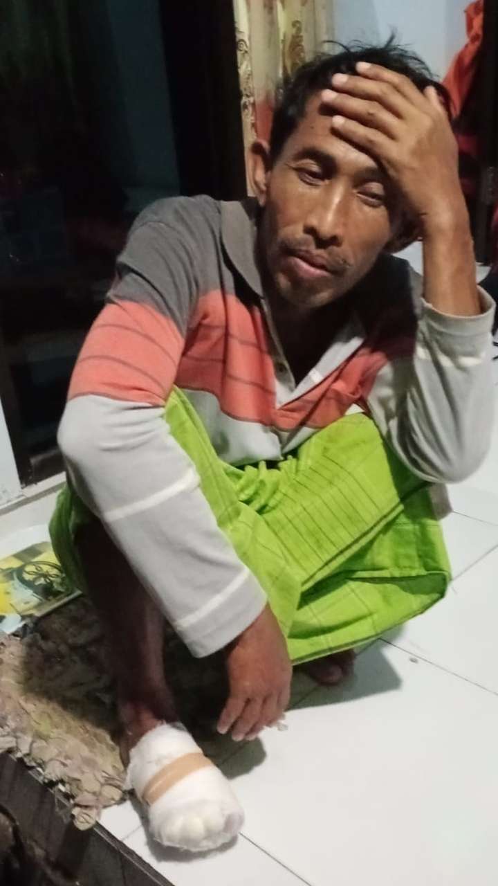 Khori Anam dengan kondisi kaki kanan terbakar lahar Semeru