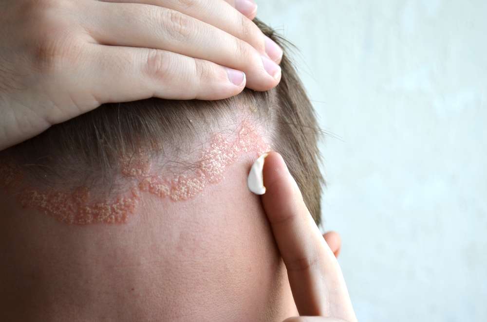 Psoriasis Pada Kulit Kepala