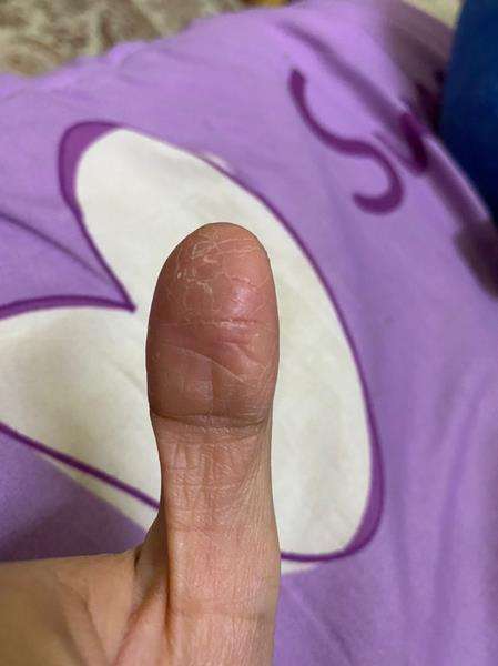 Jari-jarinya mengeriput dan mudah terluka.