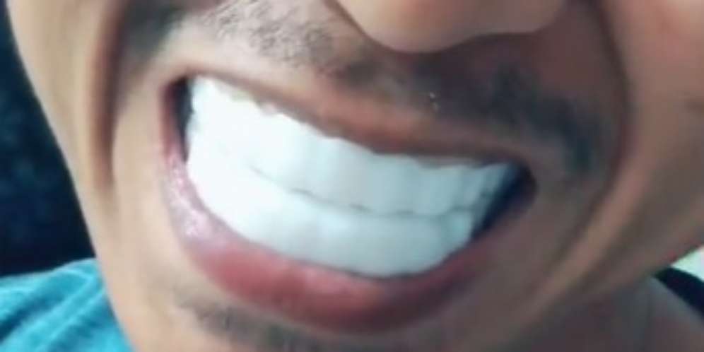 Gigi palsu Snap on Smile