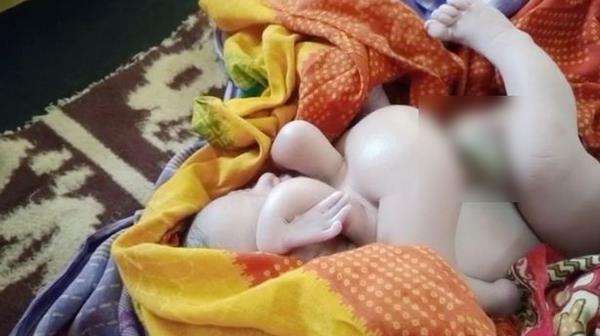 Viral, bayi lahir dengan empat tangan dan kaki dipuja sebagai titisan dewa.