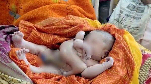 Viral, bayi lahir dengan empat tangan dan kaki dipuja sebagai titisan dewa.