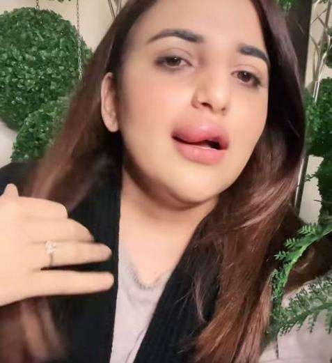 Tak mampu bayar biaya suntik filler lantaran rekening dibekukan, bibir seleb TikTok bengkak