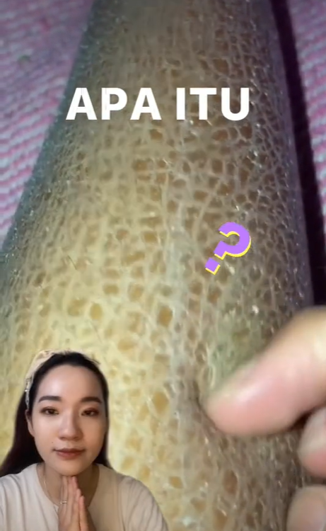 Kulit Seperti Sisik Ikan
