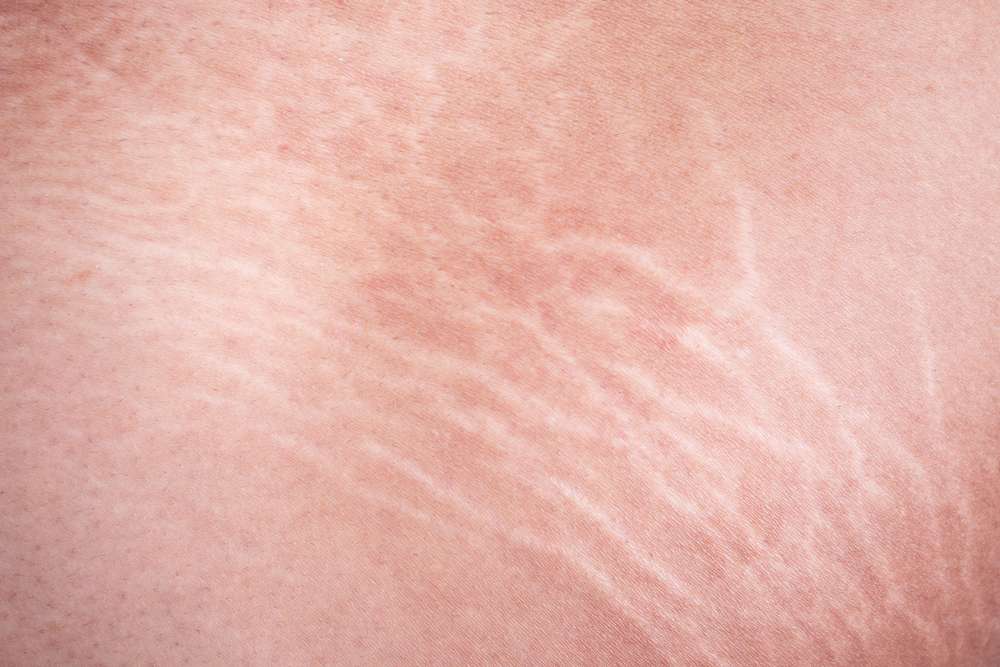 Stretch Marks