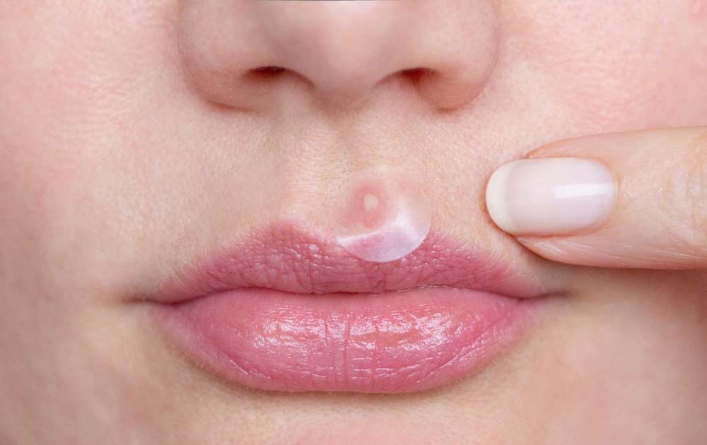 Menggunakan Acne Patch