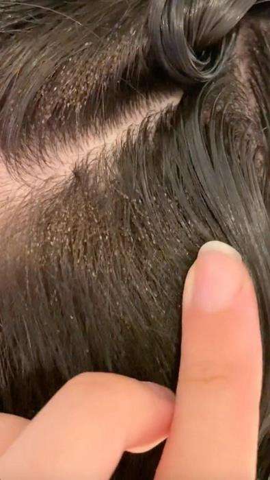 Bikin bergidik, butuh sembilan jam buat hilangkan kutu rambut.
