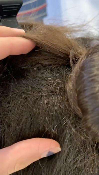 Bikin bergidik, butuh sembilan jam buat hilangkan kutu rambut.