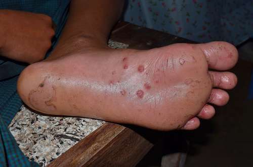 Monkeypox