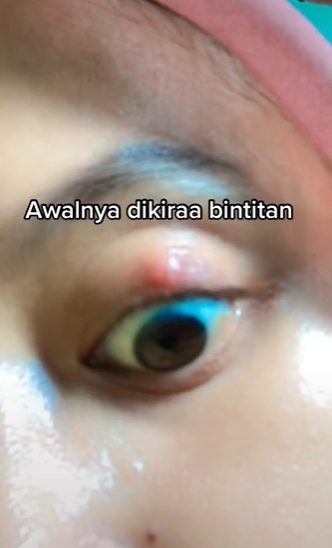 Mengalami Kalazion