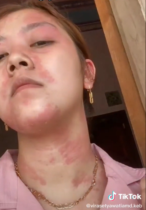 Dampak Buruk Suntik Putih