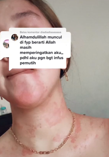 TikToker Terkena Gejala Autoimun Setelah Rutin Suntik Putih