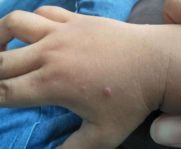 HMFD disease