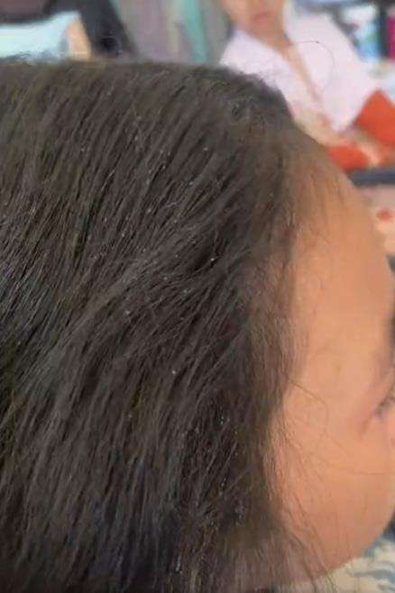 Bikin merinding, rambut penuh kutu beserta telur dan bayinya.