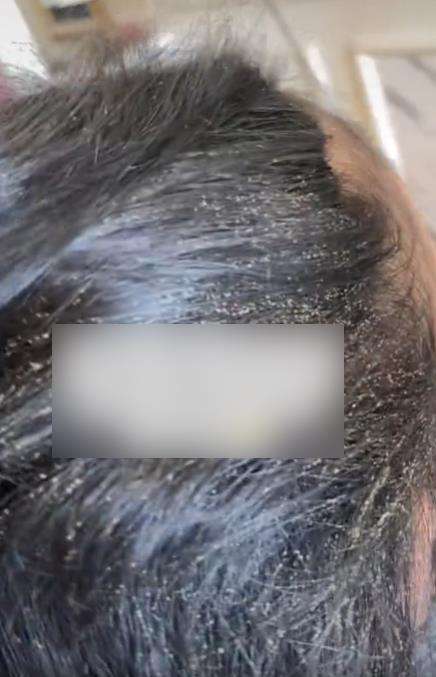 Bikin merinding, rambut penuh kutu beserta telur dan bayinya.