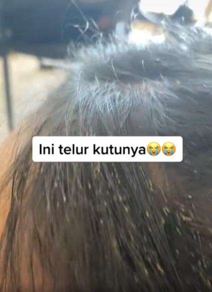 Bikin merinding, rambut penuh kutu beserta telur dan bayinya.