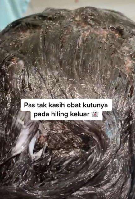 Bikin merinding, rambut penuh kutu beserta telur dan bayinya.
