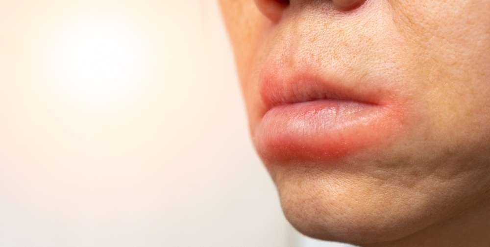 Kulit Bibir Bengkak