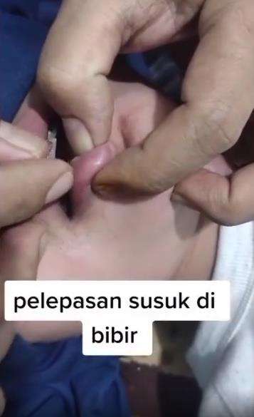 Proses pelepasan susuk bibir.