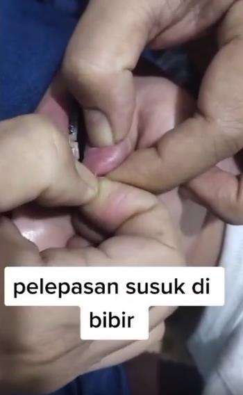 Proses pelepasan susuk bibir.
