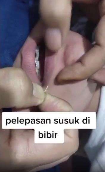 Proses pelepasan susuk bibir.