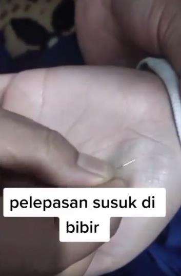 Proses pelepasan susuk bibir.