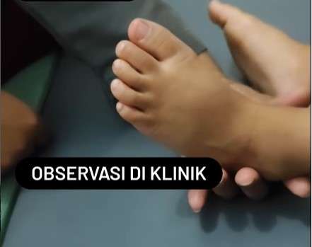 Flat Foot