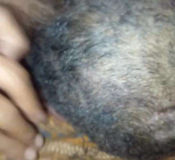 Bikin merinding, kepala nenek jadi sarang ribuan kutu rambut.