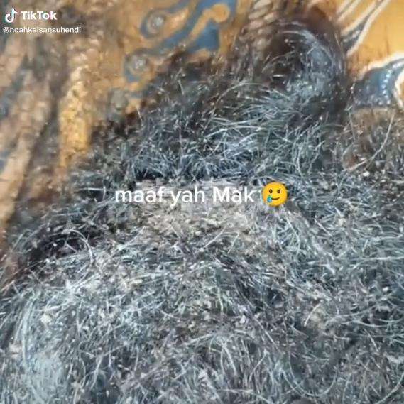 Bikin merinding, kepala nenek jadi sarang ribuan kutu rambut.