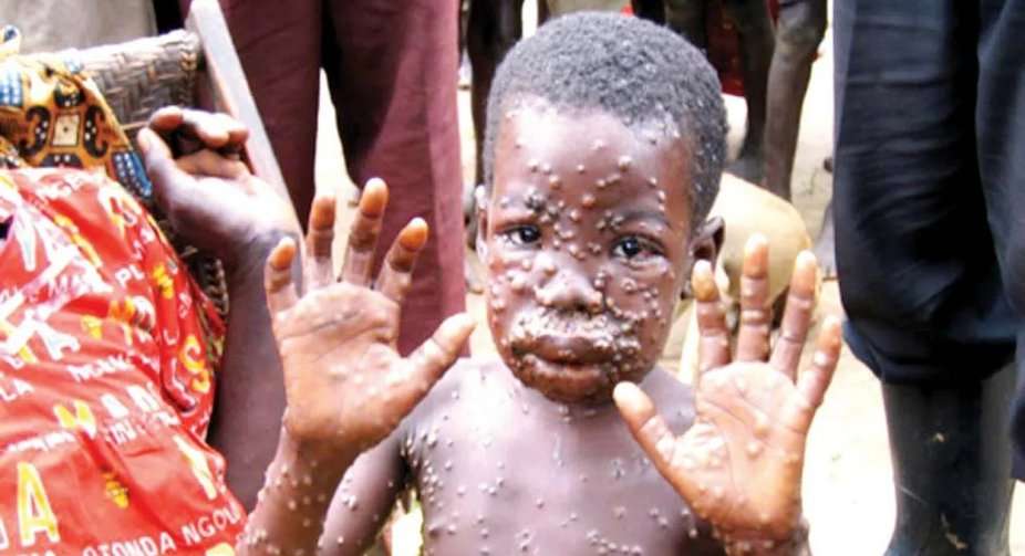 Seorang anak di Afrika dengan cacar monyet Seorang anak di Afrika dengan cacar monyet