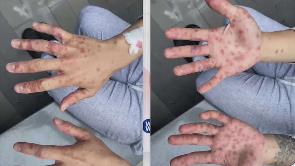 Penderita cacar monyet Penderita cacar monyet