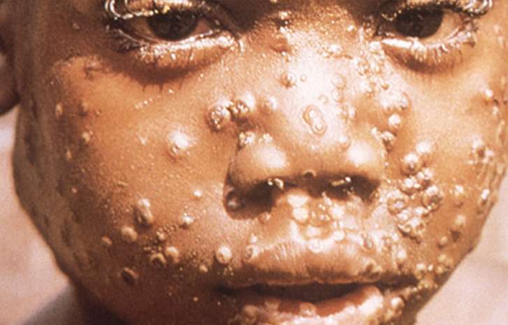 Anak yang terkena cacar monyet di Nigeria Anak yang terkena cacar monyet di Nigeria