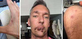 Pria di Houston, AS, terpapar cacar monyet