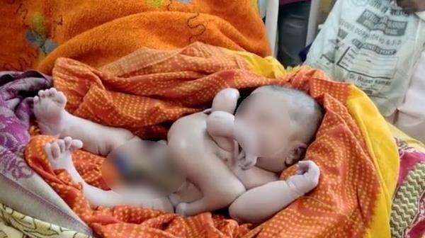 Bayi lahir cacat dianggap titisan dewa.