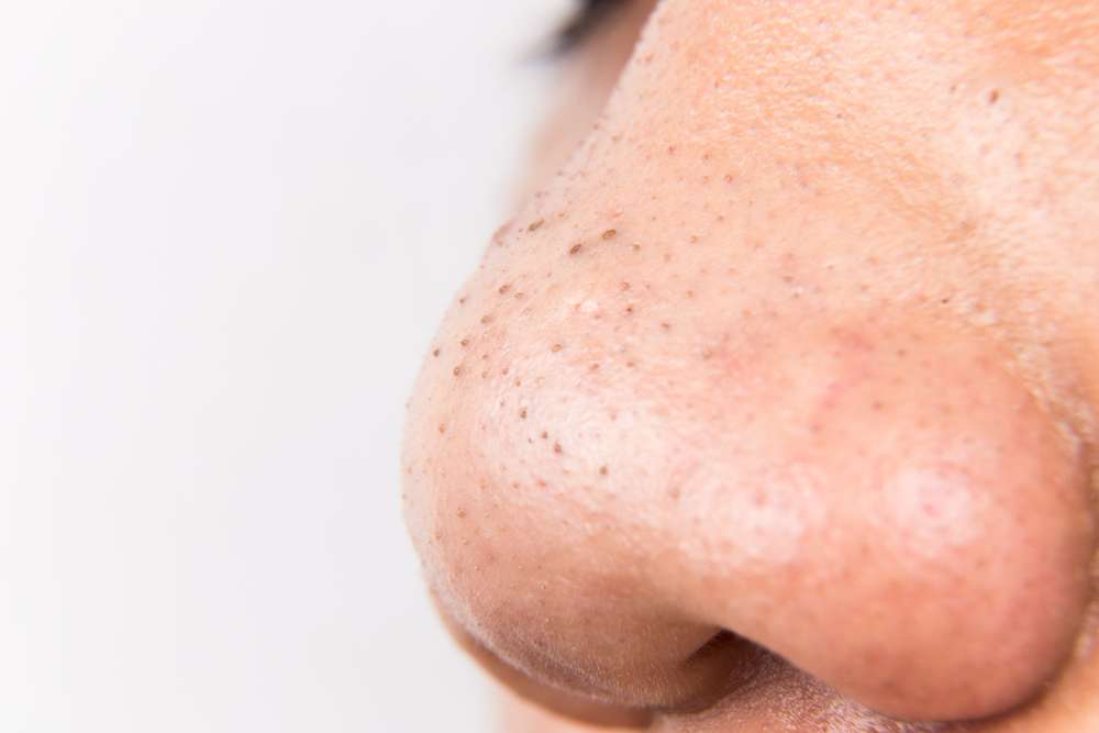 Komedo di Hidung
