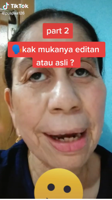 Idap Penyakit Langka, Wajah Wanita 28 Tahun Ini Berubah Seperti Wanita Usia 60 Tahunan