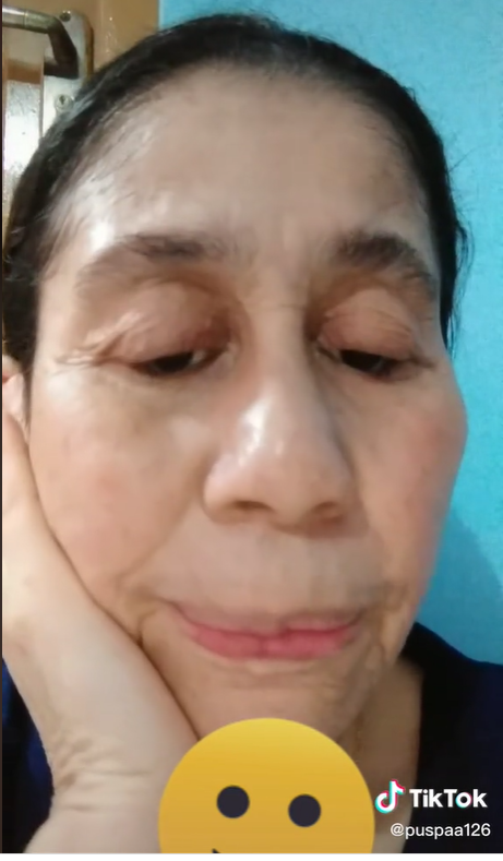 Idap Penyakit Langka, Wajah Wanita 28 Tahun Ini Berubah Seperti Wanita Usia 60 Tahunan