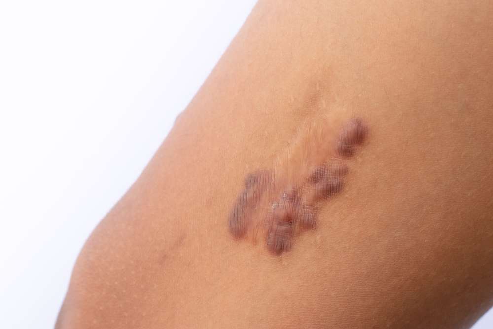 Keloid