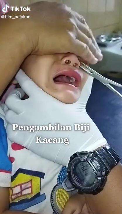 Pengambilan kacang terselip dalam hidung.