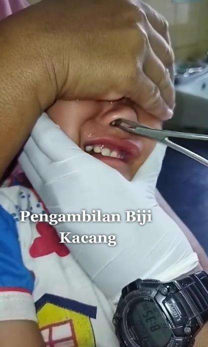 Pengambilan kacang terselip dalam hidung.