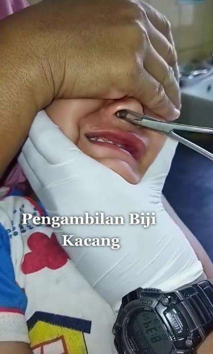 Pengambilan kacang terselip dalam hidung.