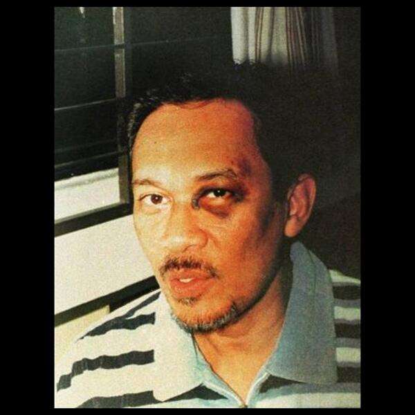 Anwar Ibrahim dengan mata hitam karena disiksa di penjara